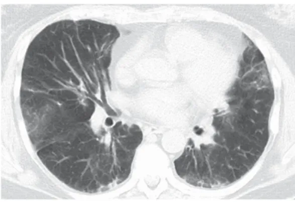 Figura 1 - TCAR da zona pulmonar inferior de um 
