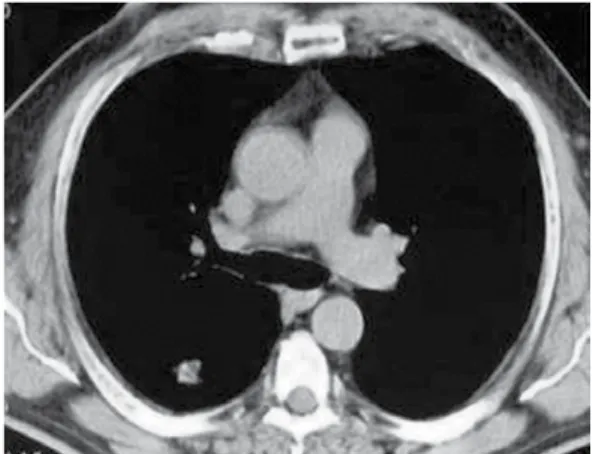 Figura 1 - TC de tórax evidenciando um nódulo de 
