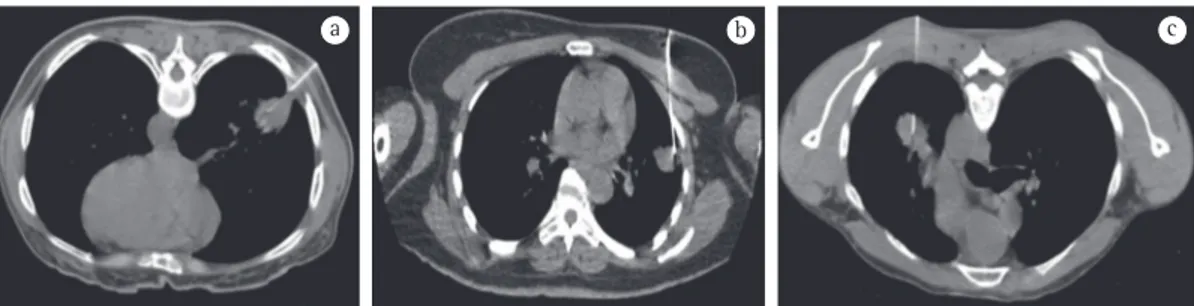 Figura 1 - Imagens de TC de pacientes com laudos citológicos sugestivos de neoplasia de linhagem epitelial  e com diagnostico final, após biopsia cirúrgica, de fibrose pulmonar (em 1a) e de granuloma com necrose  caseosa (em 1b e 1c).