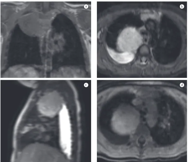Figura 7 - Imagens de ressonância magnética demonstrando ganglioneuroma. Imagem axial T1 (a), axial 