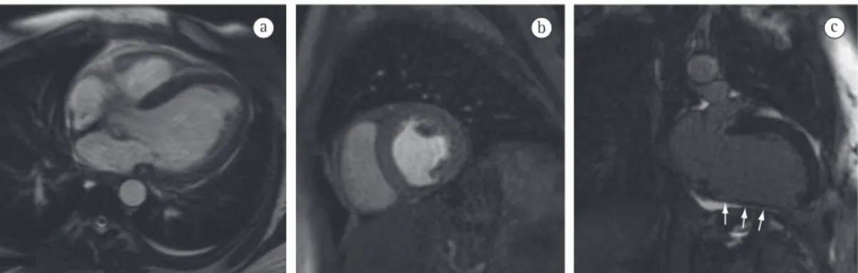 Figura 8 - Imagens de ressonância magnética cardíaca, com sequência  True-FISP  (a) no plano do eixo longo 