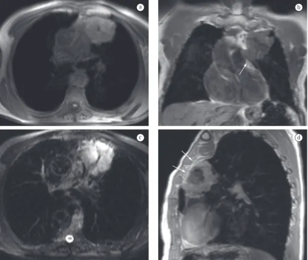 Figura 1 - Imagens de ressonância magnética demonstrando carcinoma epidermoide pulmonar como lesão 