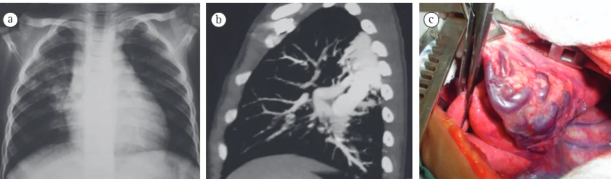 Figura 5 - Malformação arteriovenosa. Em a, radiografia de tórax evidenciando opacidade em terço superior 