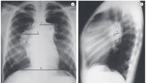 Figura 1 - Radiografia de tórax em incidência posteroanterior (em a) e em perfil (em b) de uma paciente de 28  anos portadora de hipertensão arterial pulmonar idiopática