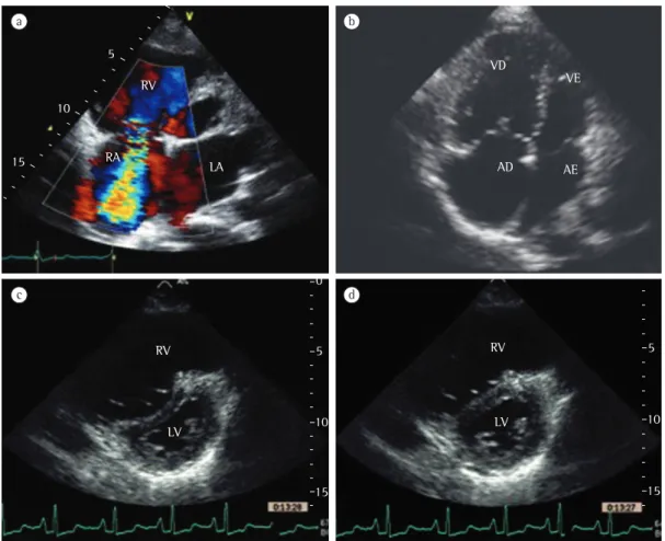 Figura 3 - Imagens de ecocardiografia. Notar a intensidade do sinal do jato de regurgitação tricúspide durante  a sístole ventricular com o uso de Doppler contínuo (em a) e a dilatação das câmaras cardíacas direitas (em  b)