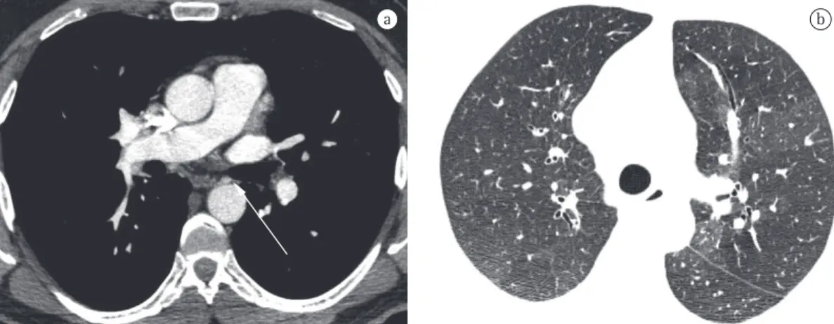 Figura 5 - Imagens de angio-TC (em a) e TCAR (em b) de um paciente portador de hipertensão pulmonar  trombótica