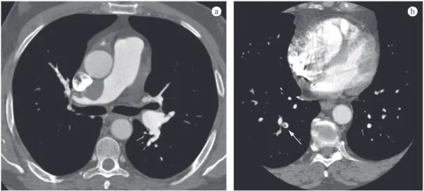 Figura 6 - Imagens de angio-TC de pacientes com tromboembolismo crônico (em a) e agudo (em b)
