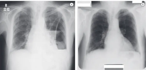 Figura 1 - Radiografias de tórax: (a) logo após a internação, revelando uma bolha gigante com nível líquido  no pulmão esquerdo (à esquerda); (b) um ano antes, sem nenhuma alteração.
