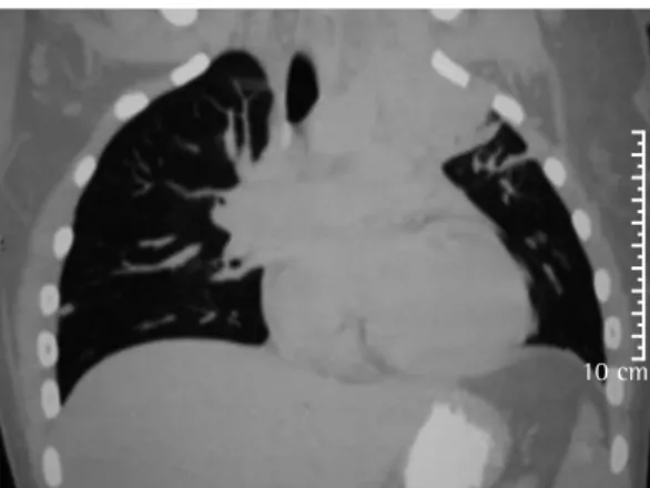Figura 3 - TC de tórax da janela pulmonar.