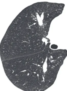 Figura 8 - Reformatação coronal de TCAR de tórax 