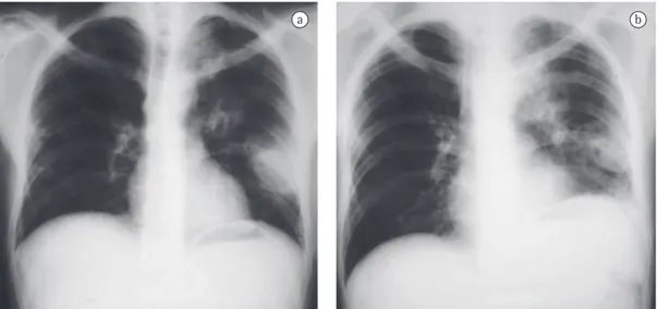 Figura 1 - Radiografia de tórax de um paciente com leucemia, mostrando cavidades (em A) e consolidação 