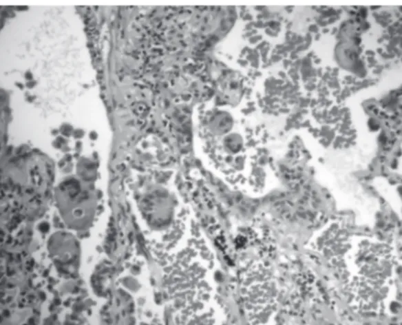 Figura  3  -  Exame  histopatológico  revelando  células 