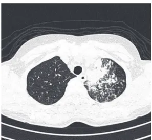 Figura  4  -  Radiografia  de  tórax  após  o  término  do  esquema  I  de  tratamento  da  tuberculose,  demonstrando importante melhora.