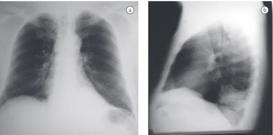 Figura 1 - Radiografia de tórax em incidência anteroposterior (em a) e em perfil (em b)