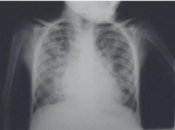Figura 3 - Radiografia de tórax revelando infiltrado 