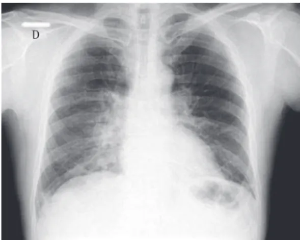 Figura  1  -  Radiografia  de  tórax  na  admissão 