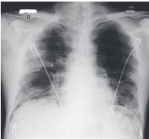 Figura 3 - Radiografia de tórax na alta hospitalar.