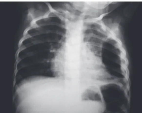 Figura  1  -  Radiografia  de  tórax  demonstrando  a  presença  de  pneumatocele  e  pequenas  cavidades  aéreas em terço inferior do pulmão esquerdo, além de  obliteração do seio costofrênico.