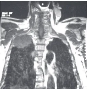Figura 2 - Tumor de Pancoast. Ressonância magnética 