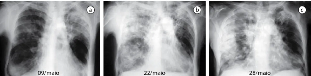 Figura 1 - Pneumonia eosinofílica crônica idiopática. Paciente de 71 anos, feminina, asmática, com sinais de 