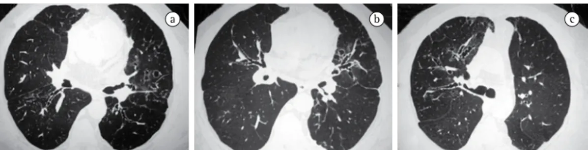 Figura 4 - Aspergilose broncopulmonar alérgica. Paciente de 37 anos, masculino, com asma grave córtico-