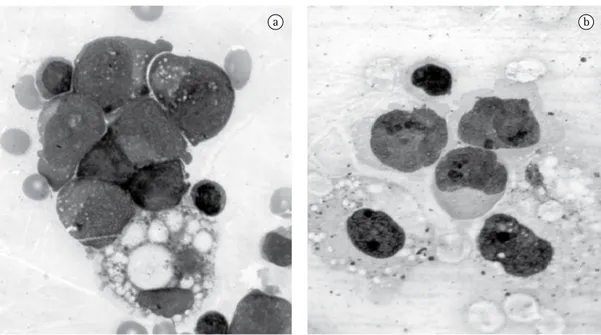 Figura 1 - Citologia do líquido pleural. Em a), células neoplásicas dispostas em agrupamentos coesos