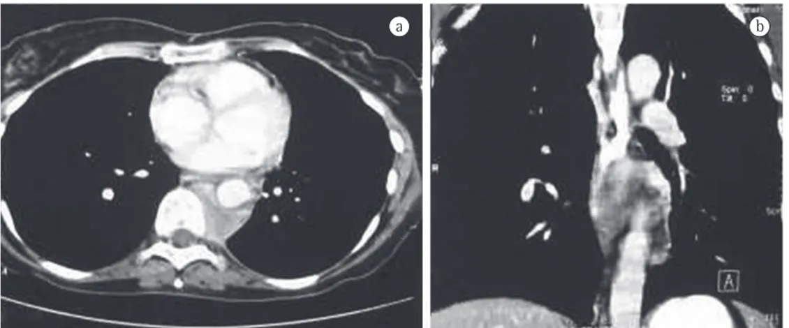 Figura 1 - Massa paravertebral esquerda no mediastino posterior: a) imagem axial; b) imagem de reconstrução 
