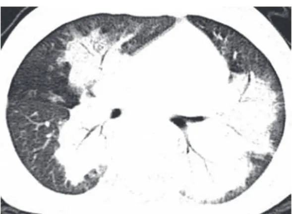 Figura 2 - TCAR de tórax, mostrando extensas áreas 