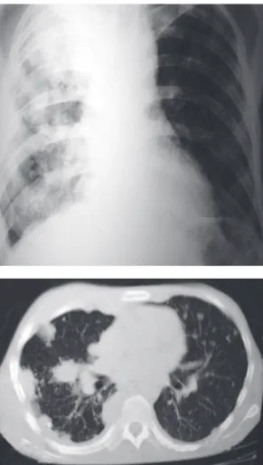 Figura 2 - Coccidioidomicose: a) a radiografia revela 