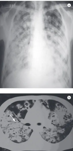 Figura 3 - Coccidioidomicose pulmonar aguda, com 