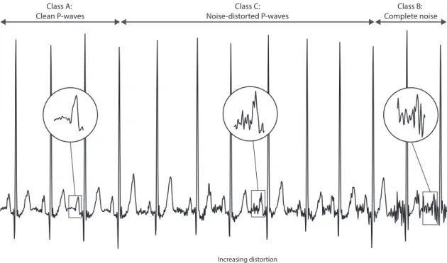 Figure 4.1: P-waves were classified into three different classes: high quality clean P-waves (class A), complete noise or absent waves (class B), and unreliable, noise-distorted  P-waves (class C)