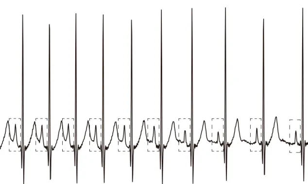 Figure 4.4: P-wave morphology variation over time due to physiological variations. The extracted P-wave signal (dotted box) starts by being asymmetrical and containing the T-wave from the previous beat, and ends up symmetrical and containing the surroundin