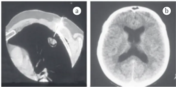 Figura  1  -  Paciente  masculino,  branco,  50  anos,  transplantando  renal  há  8  anos,  com  nódulo  escavado na cortical pulmonar sendo puncionado (a)