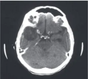 Figura 3 - Tomografia computadorizada crânio-axial  revelando  criptococoma  no  lobo  temporal  direito  e  múltiplos nódulos dispersos pelo parênquima cerebral