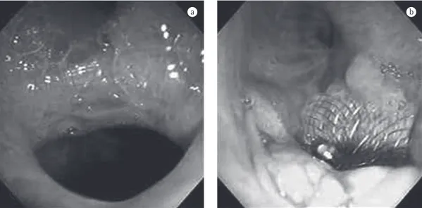 Figura  1  - Em a), fístula broncopleural após lobectomia superior direita. Em b), aspecto após 180 dias da  permanência da prótese.