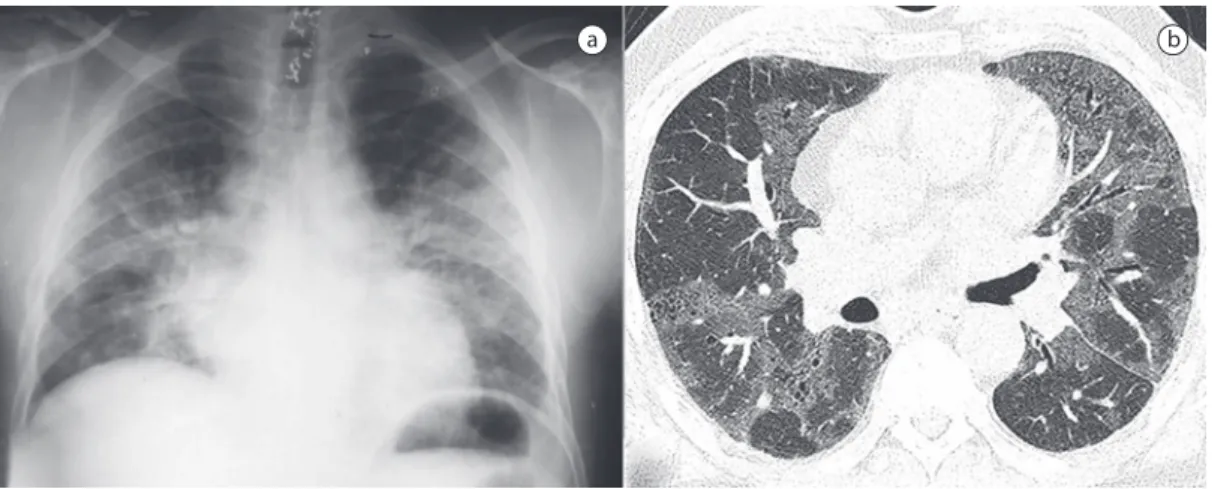 Figura  1  -  Em  a),  radiografia  de  tórax  evidenciando  infiltrado  intersticial  bilateral  (1996);  em  b),  TCAR 