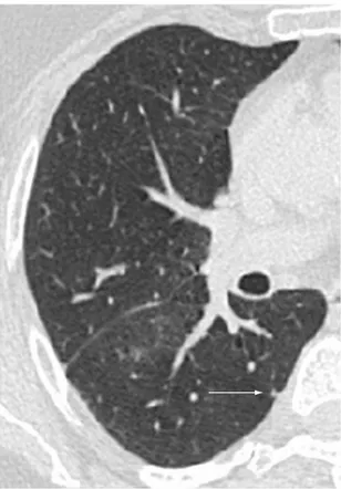 Figura 5 - Hilo pulmonar: falso positivo do diagnóstico 