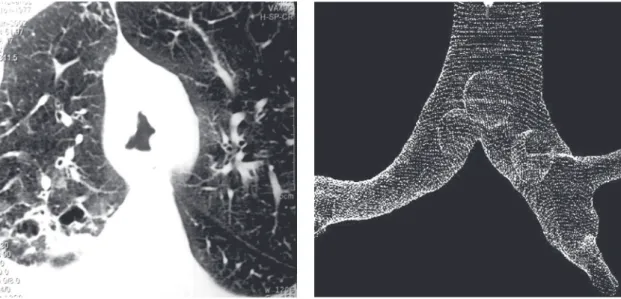 Figura 5 - Linfoma. Tomografia evidenciando nodulações 