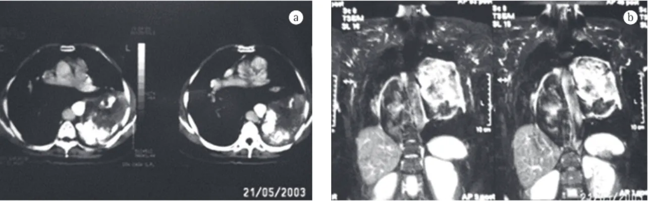 Figura 2 - Imagens de tórax: a) Cortes tomográficos altos em que o tumor só aparece do lado esquerdo, junto ao sulco 
