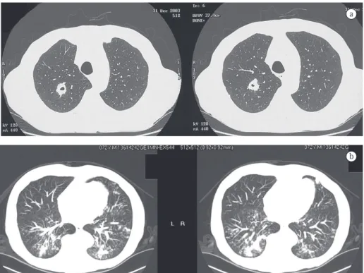 Figura 1 - a) Tomografia computadorizada de tórax de alta resolução revelando nódulo escavado; e b) Tomografia 
