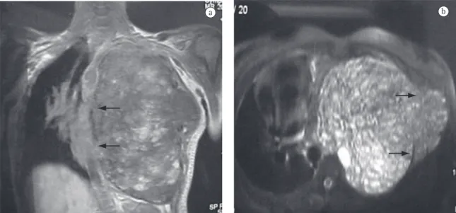 Figura 1 - a) Ressonância magnética mostrando massa ocupando todo o hemitórax e desviando o mediastino para a 