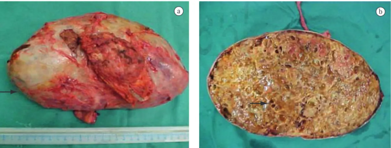 Figura 2 - a) Peça operatória: tumor encapsulado sólido com aspecto externo mostrando cápsula bem definida (seta); 