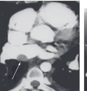 Figura 1 - Trombo na artéria pulmonar. Figura 2 - Trombo em átrio direito.