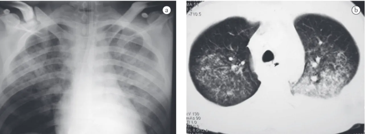 Figura 2 - a) Radiografia de tórax, ainda na sala operatória, mostrando consolidação predominante em ápice e campo 