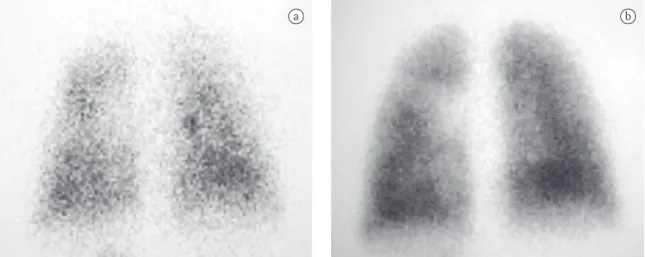Figura 1 - Mapeamento de inalação (a) e perfusão (b) pulmonar (visão posterior) evidenciando captação homogênea 