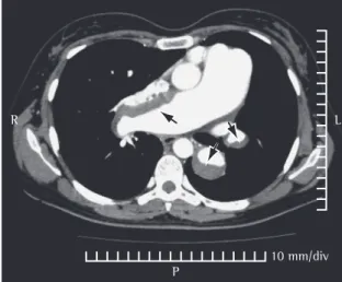 Figura 2 - Angiotomografia de tórax (2004) ao nível do 