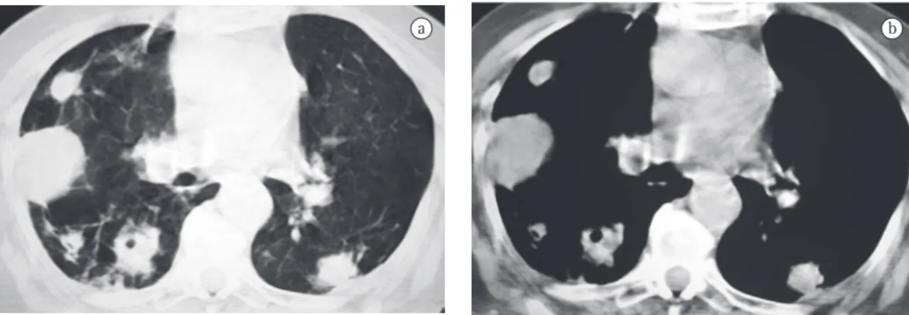 Figura  2  -  Tomografias  computadorizadas  com  janela  para  parênquima  pulmonar  a)  e  mediastino  b),  mostrando 