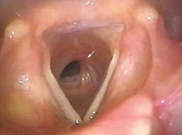 Figura 3 - Broncoscopia: estenose laringo-traqueal.