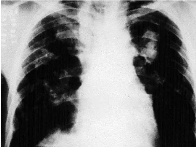 Figura 3 - Fotomicrografia de tecido pulmonar com septos 