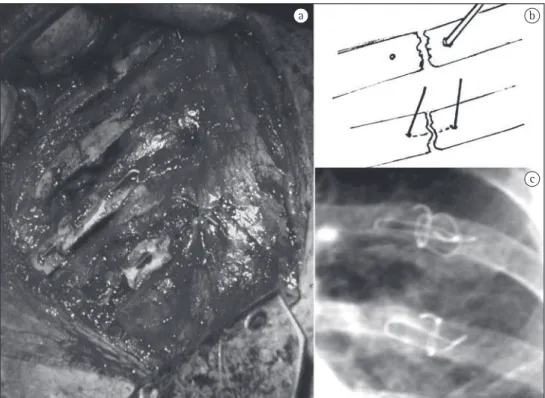Figura 3 - Ato cirúrgico: a) fraturas reduzidas e passagem do fio de aço; b) técnica esquemática da sutura costal; e  c) aspecto ao RX.